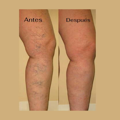 NUEVO VENOSPLUS® Spray mentolado