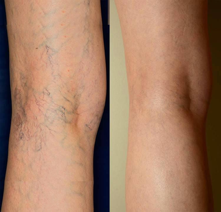 NUEVO VENOSPLUS® Spray mentolado